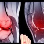 Explore Different Ligament Injuries treatment in delhi In The Body