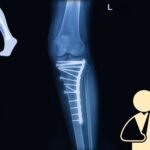 tibia fracture treatment ghaziabad Uttar pradesh