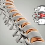 Spinal Fractures type and Best Orthopedic Treatment in ghaziabad UP
